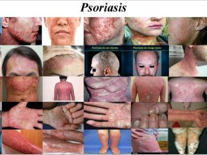 Le Psoriasis