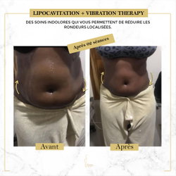 Avant / Après du traitement de lipocavitation + vibration thérapy
